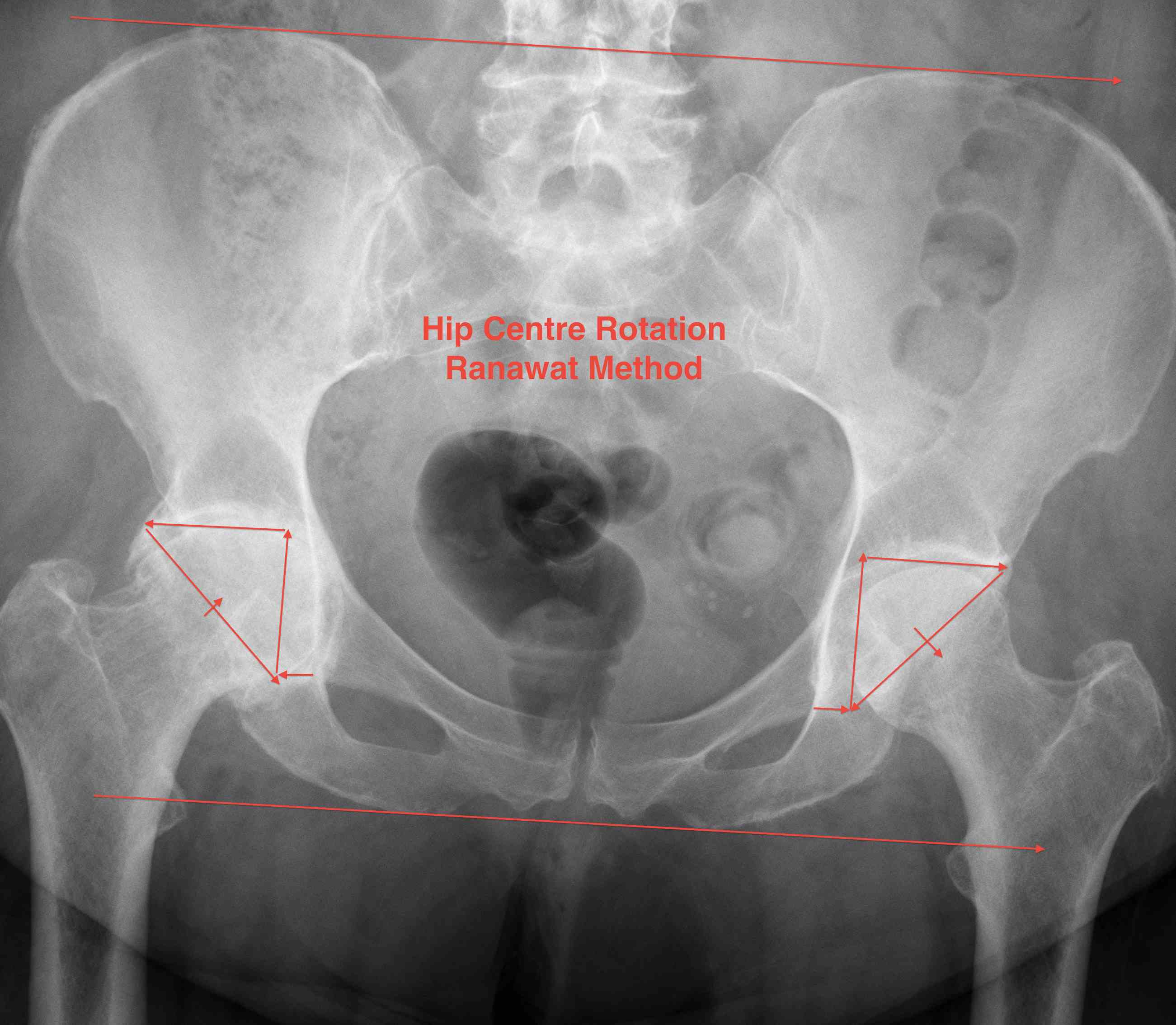 Hip Protrusio Ranawat Method Centre Rotation